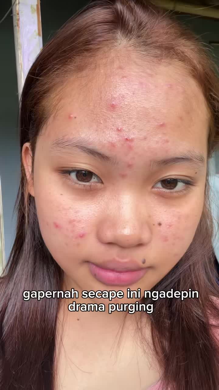 Pertama kali coba serum Salicylic Acid yang encapsulated dan langsung setia sama Acne Pure Glow Fx. Formulanya gacor banget, kombinasi anti jerawat, calming, dan anti bakteri. Jerawat literally hempas no drama purging & minim bekas.