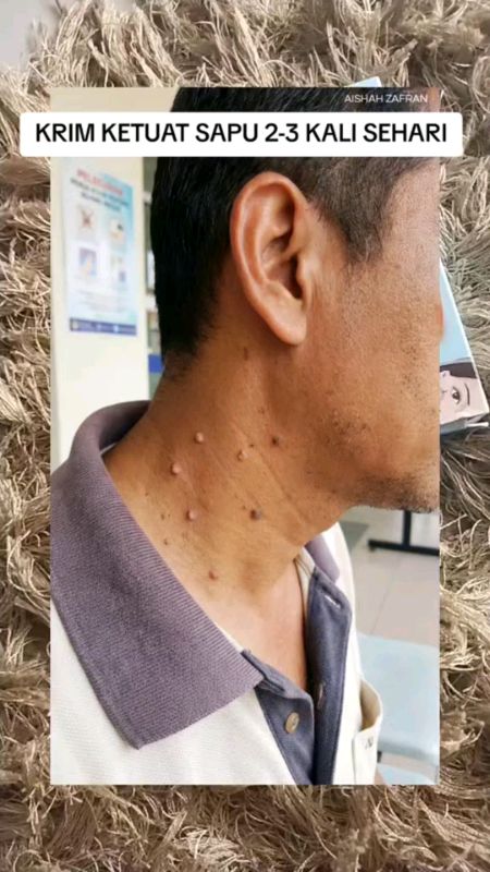 #skintag#skintagremoval#creambuangskintag#creamoonwartremovalcream#moleremover#bijikolestrol