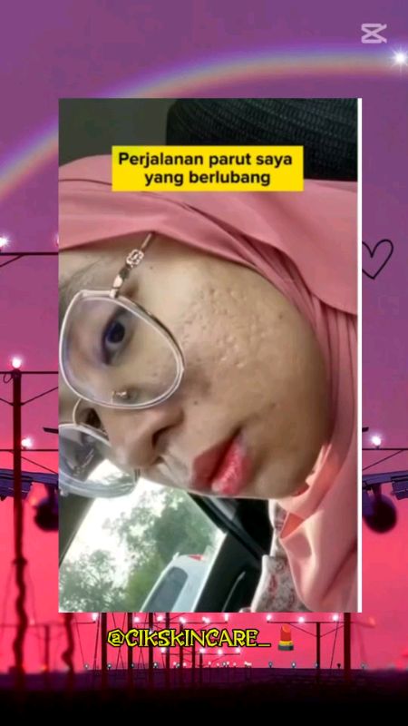 VERBLE ACNE CARE #verble #Shopevideo #shopehaul #foryou #fypp